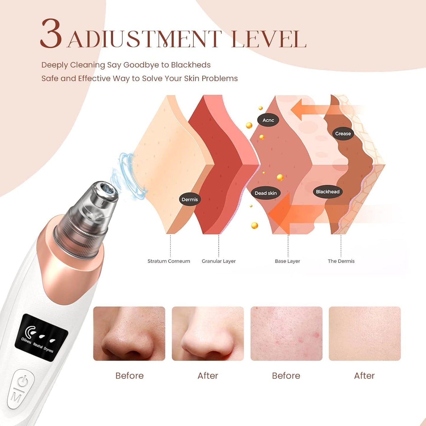 Blackhead Remover Pore Vacuum,Facial Pore Cleaner-5 Suction Power,5 Probes,USB Rechargeable Blackhead Vacuum Kit Electric Acne Extractor Tool for Adult